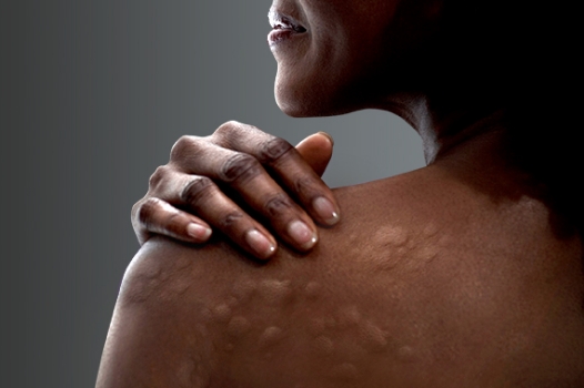 woman with chronic hives on her back